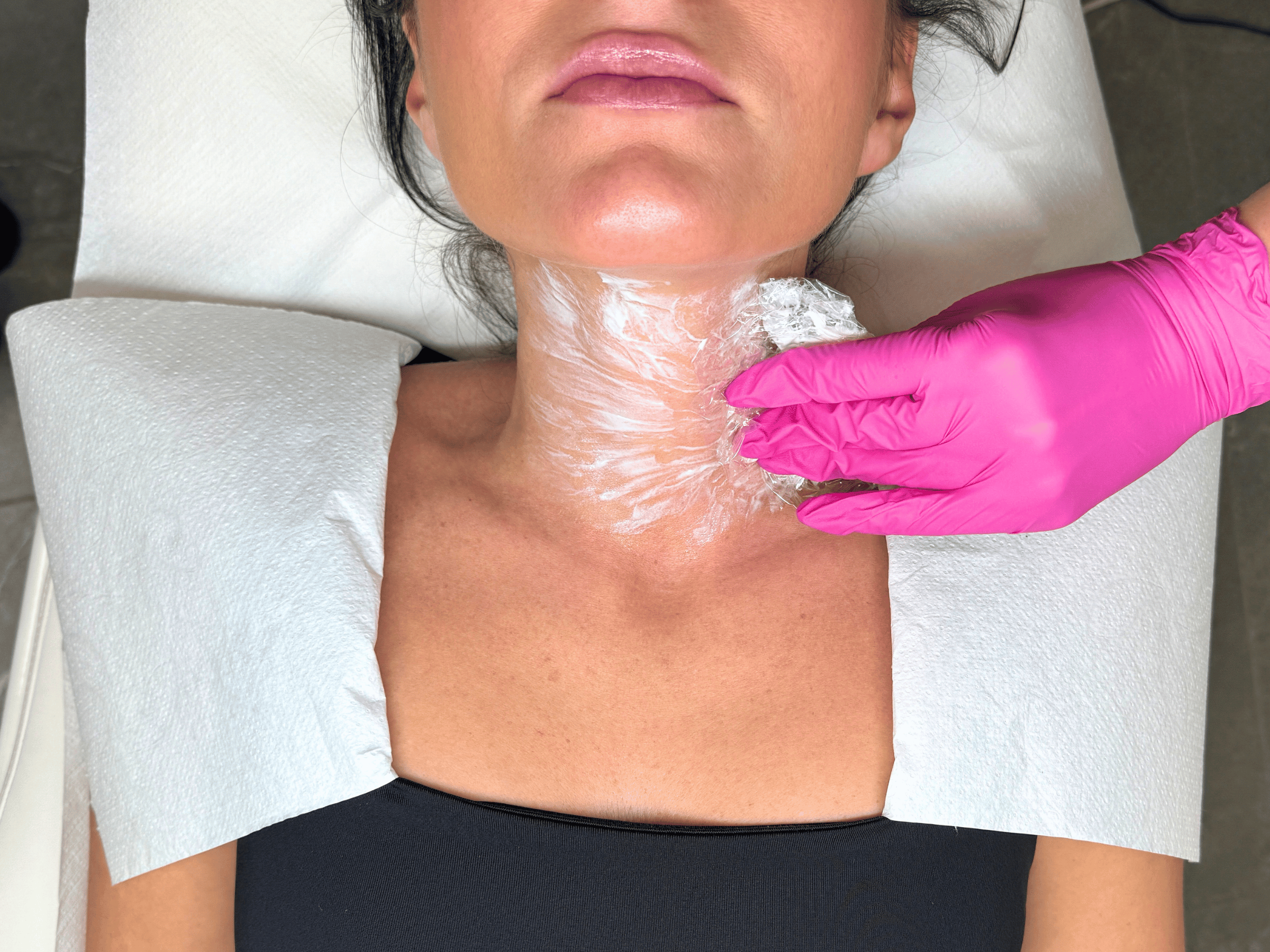 Wykonywanie mezoterapii igłowej na szyi