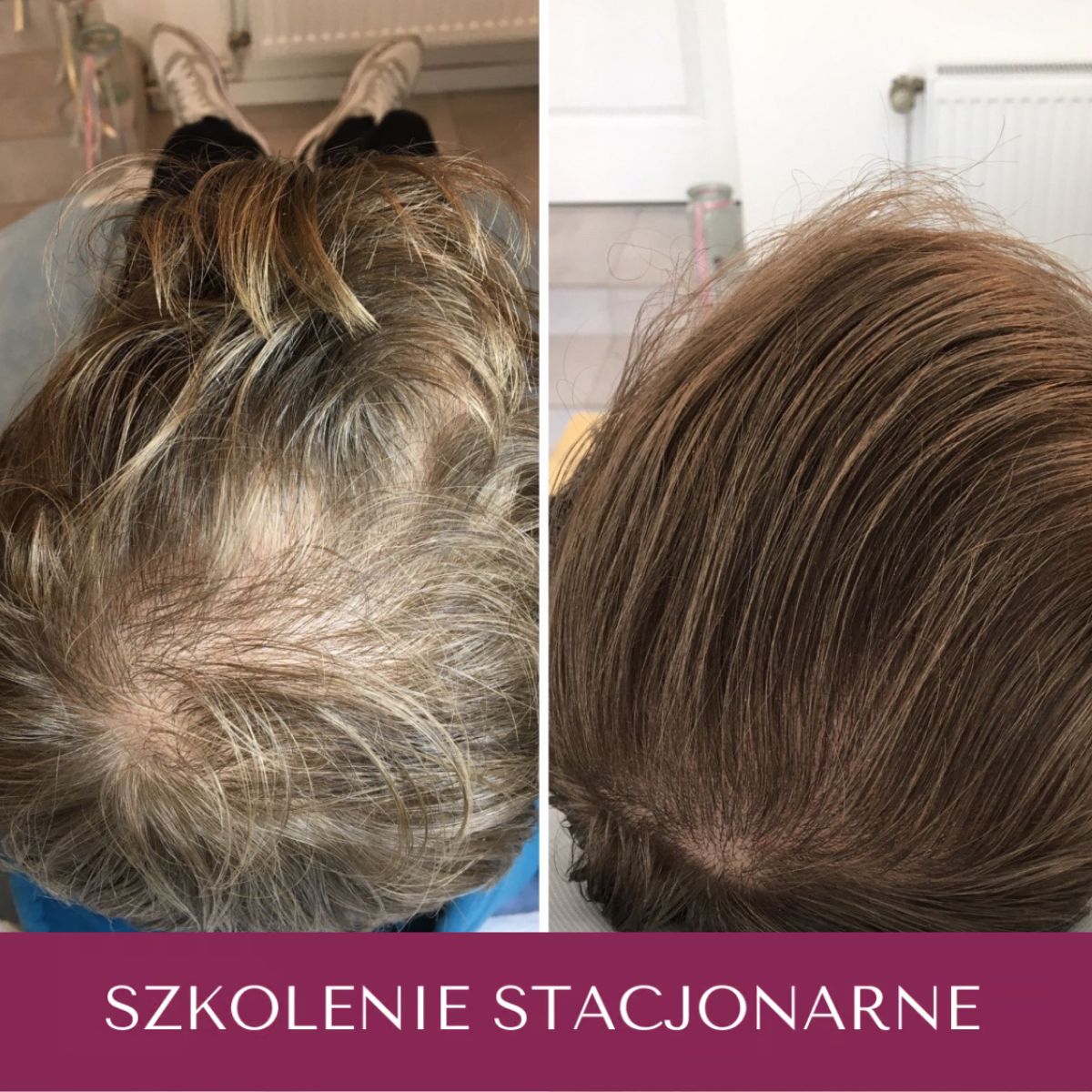 Szkolenie z podstaw Trychologii