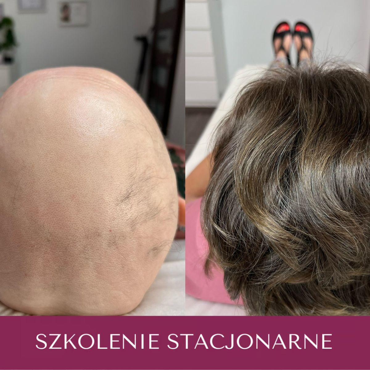 Szkolenie z Trychologii poziom zaawansowany